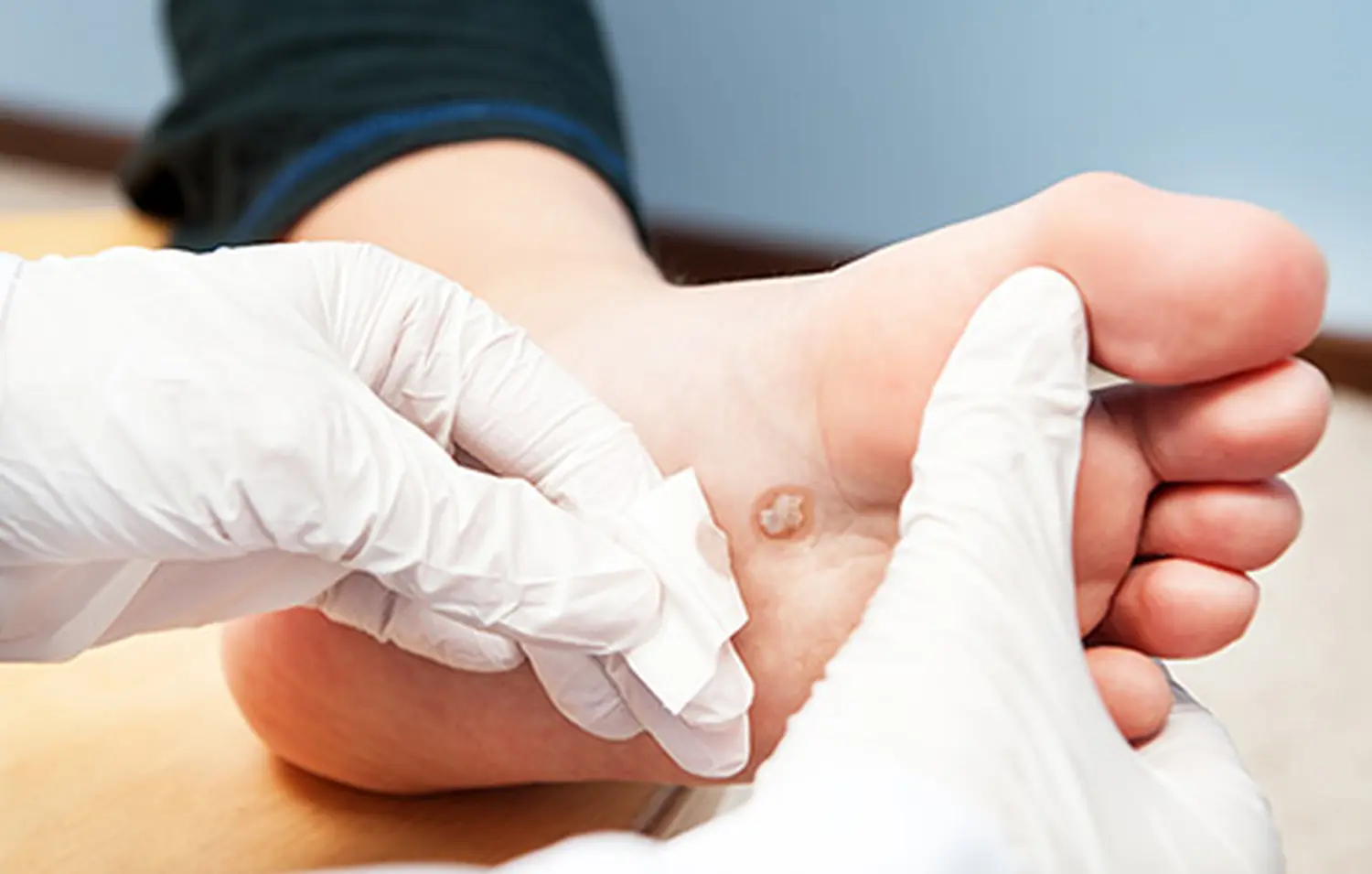 Beauty-Residenz Paderborn Warzenvereisung